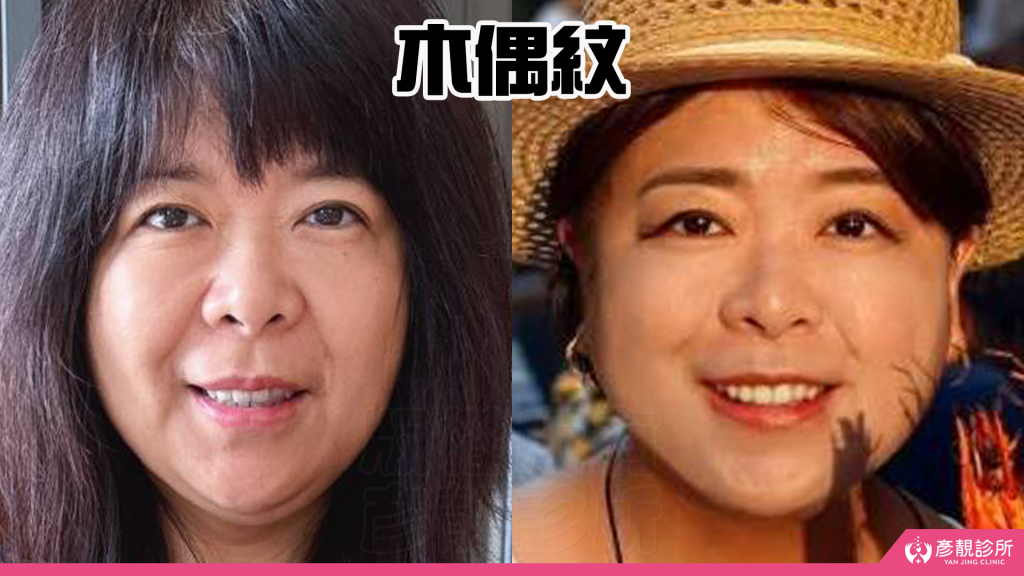 【台北醫美評價】台北彥靚診所|松江南京站:4D無痕筋膜提升 打造精緻V線!擺脫木偶紋雕塑輪廓線真實心得 25 overfilled face treatment