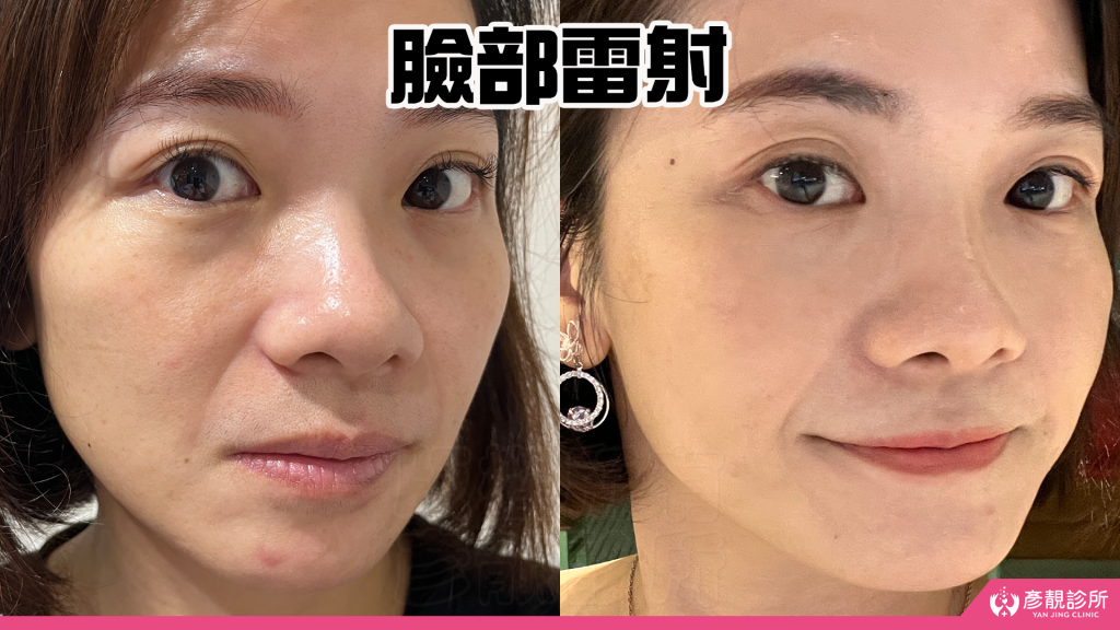 40歲後肌膚真的可以變好嗎?我的蜂巢皮秒雷射斑點改善完整紀錄分享|彥靚診所 43 picocare freckle treatment