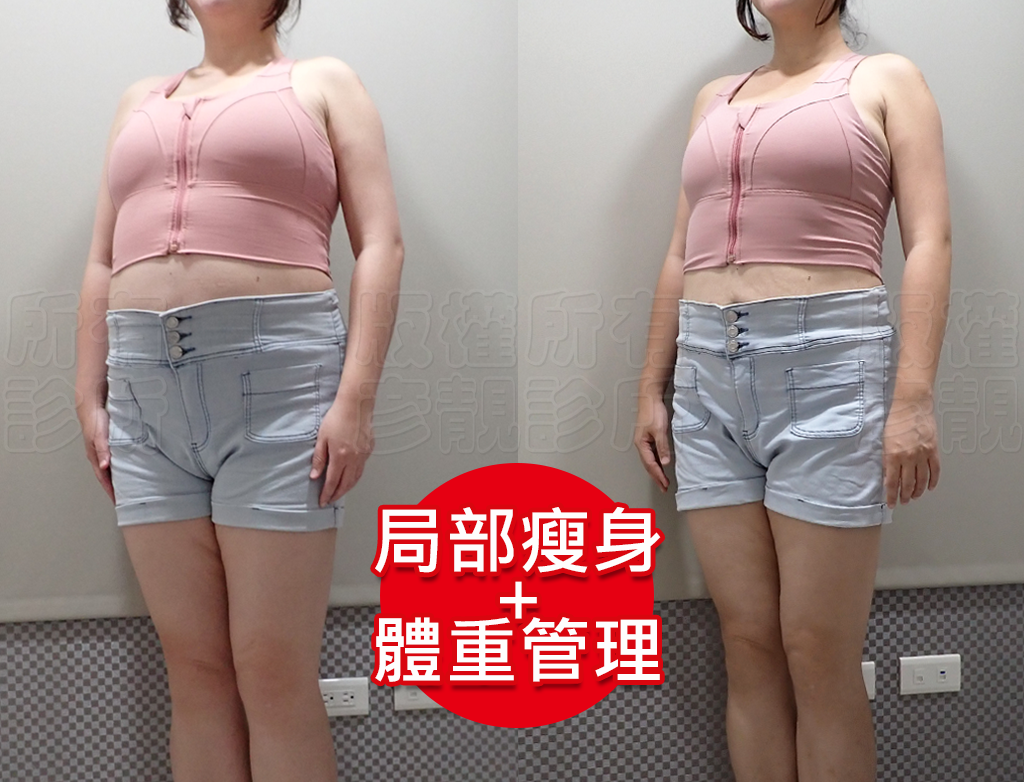 減重門診推薦|彥靚診所減重12公斤實錄:飲食控制、健身、旅行與外食經驗分享 40 postpartum slimming