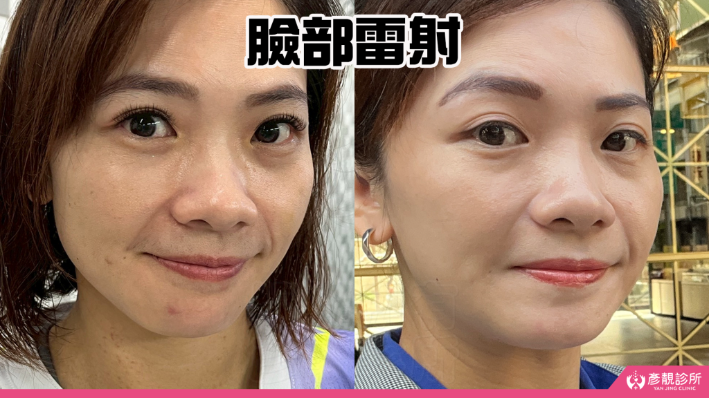 40歲後肌膚真的可以變好嗎?我的蜂巢皮秒雷射斑點改善完整紀錄分享|彥靚診所 45 skin brightening laser
