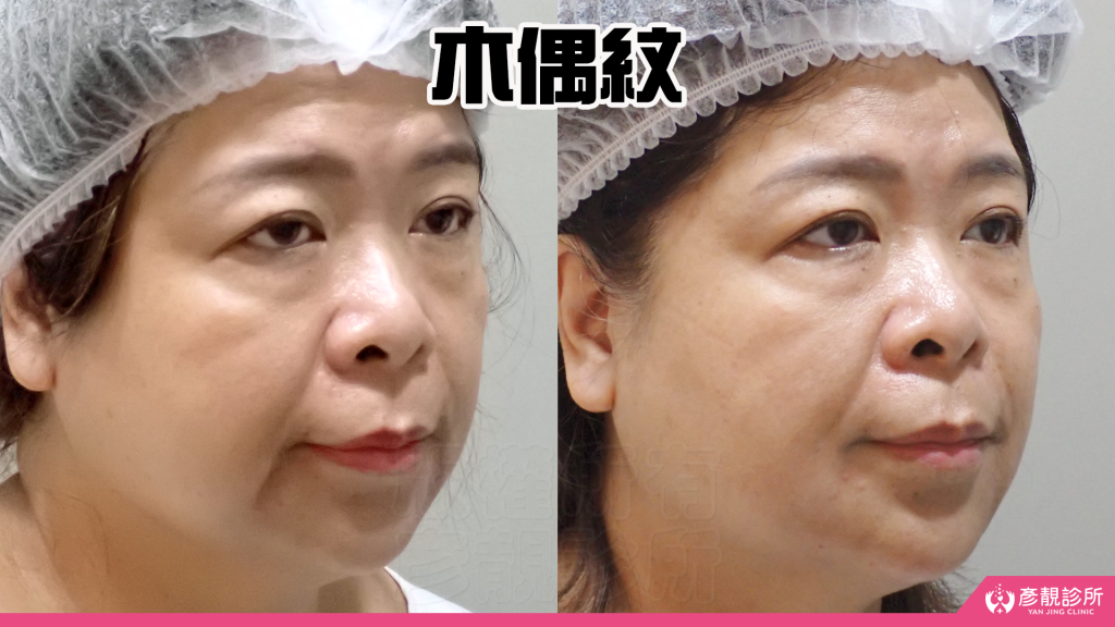 【台北醫美評價】台北彥靚診所|松江南京站:4D無痕筋膜提升 打造精緻V線!擺脫木偶紋雕塑輪廓線真實心得 21 taipei facial contouring