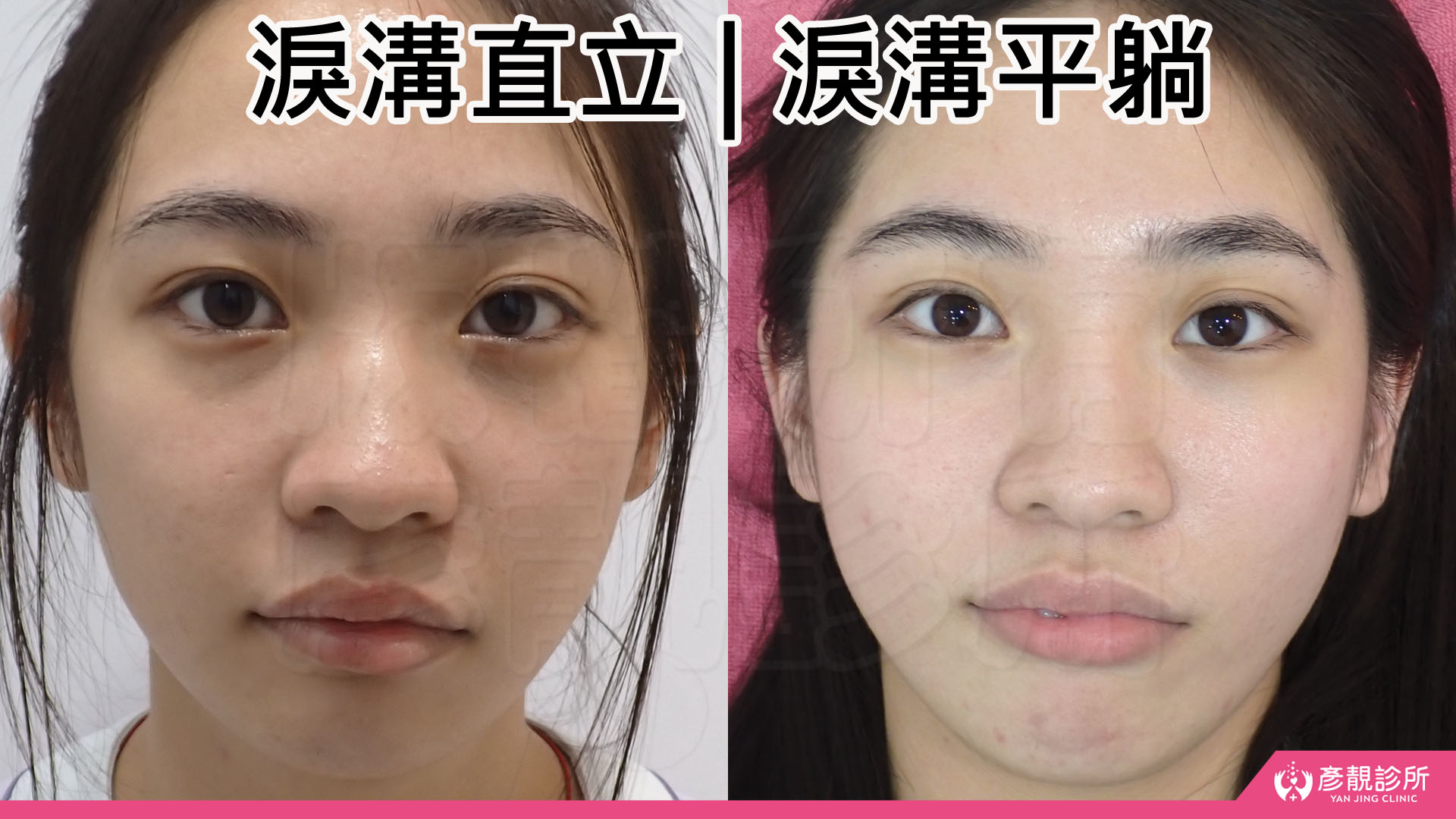淚溝怎麼改善?先辨黑眼圈成因,再選適合的療程 5 坐著與躺下的淚溝陰影對照