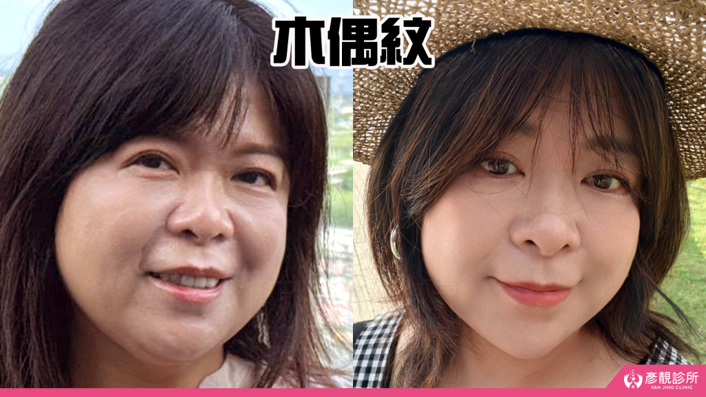 【台北醫美評價】台北彥靚診所|松江南京站:4D無痕筋膜提升 打造精緻V線!擺脫木偶紋雕塑輪廓線真實心得 24 v line chin treatment