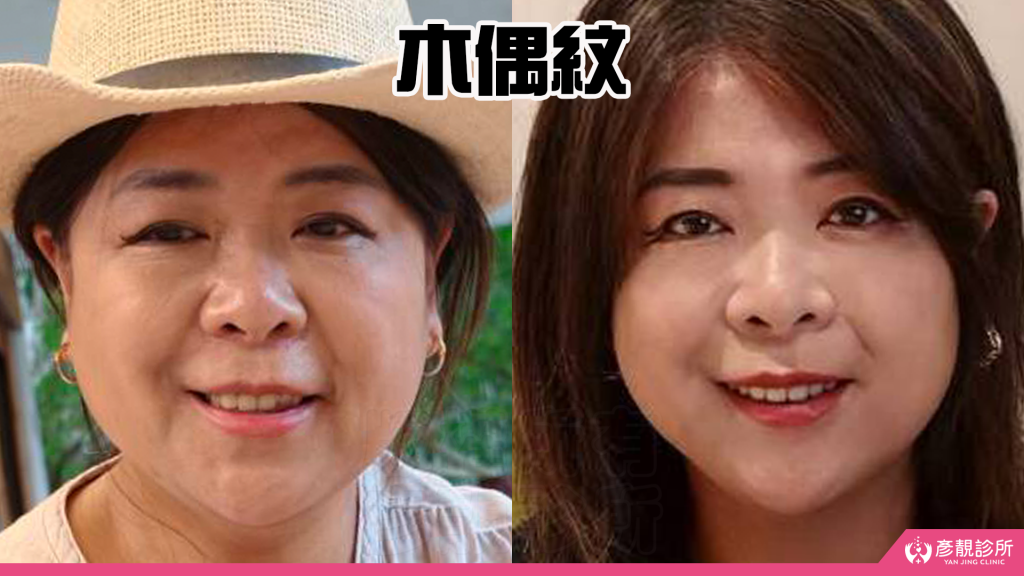 【台北醫美評價】台北彥靚診所|松江南京站:4D無痕筋膜提升 打造精緻V線!擺脫木偶紋雕塑輪廓線真實心得 26 v line facial contouring