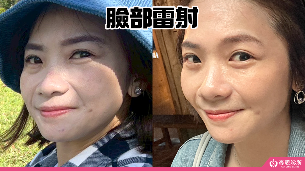 40歲後肌膚真的可以變好嗎?我的蜂巢皮秒雷射斑點改善完整紀錄分享|彥靚診所 44 yanjing dark spot treatment