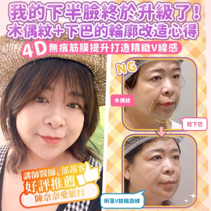 【台北醫美評價】台北彥靚診所|松江南京站:4D無痕筋膜提升 打造精緻V線!擺脫木偶紋雕塑輪廓線真實心得 1 yanjing v line treatment