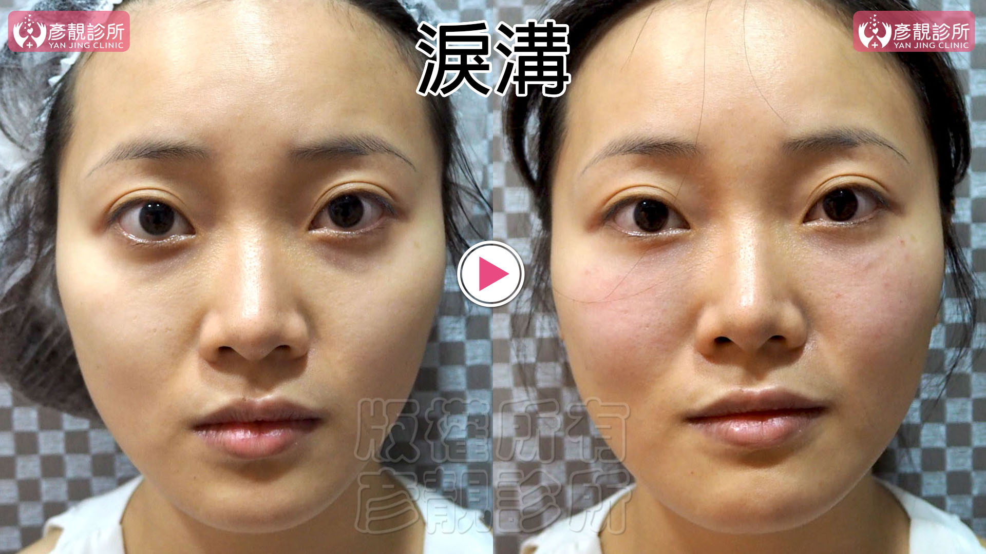 洢蓮絲(俗稱少女針)與大分子玻尿酸怎麼選?淚溝效果、持久度與費用 1 大分子玻尿酸淚溝術前術後對照,左圖兩側眼頭下方有明顯凹陷陰影,右圖填補後陰影變淡,眼下較明亮,臥蠶仍可辨認。彥靚診所黃政達醫師以局部填補改善疲倦外觀,並保留原有眼型與眼周層次。
