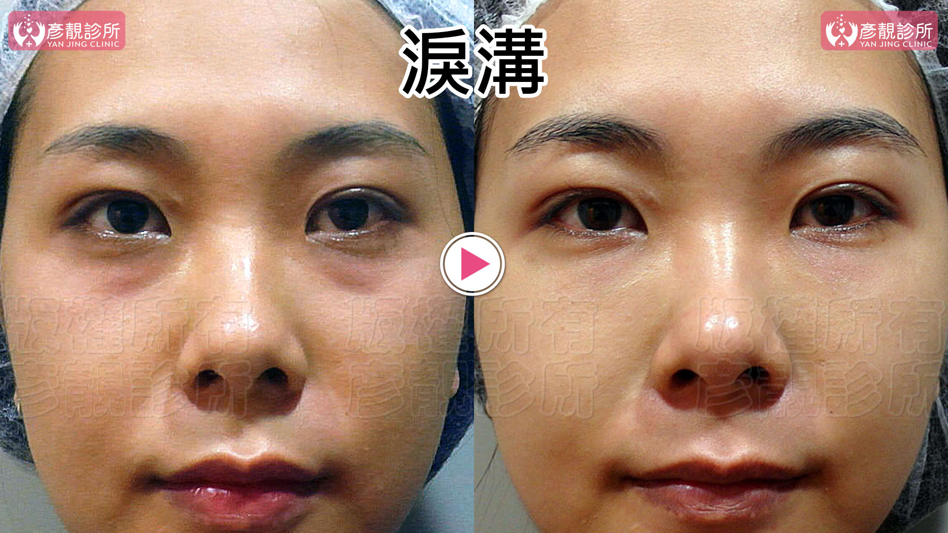 洢蓮絲(俗稱少女針)與大分子玻尿酸怎麼選?淚溝效果、持久度與費用 3 女性淚溝填補前後正面照,左圖下眼皮與臉頰間有明顯凹影,右圖使用大分子玻尿酸後,淚溝變淺,臥蠶與其下方的自然線條仍保留。黃政達醫師將需要改善的淚溝和應保留的眼周層次分開規劃。