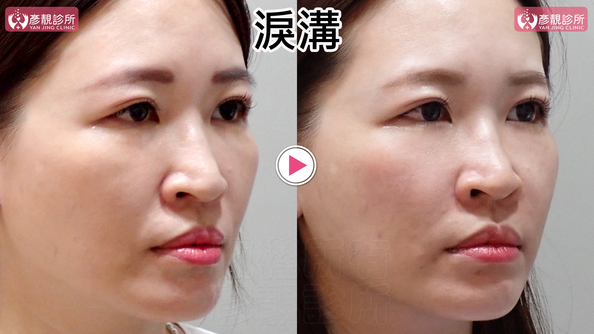 洢蓮絲(俗稱少女針)與大分子玻尿酸怎麼選?淚溝效果、持久度與費用 6 女性眼周斜側術前術後照,左圖內眼角下方的淚溝陰影較深,右圖用大分子玻尿酸改善後,凹影變淡,眼下較明亮,臥蠶仍維持自然隆起。這組外觀呈現填補淚溝與保留臥蠶可以同時做到,眼睛仍有立體感。