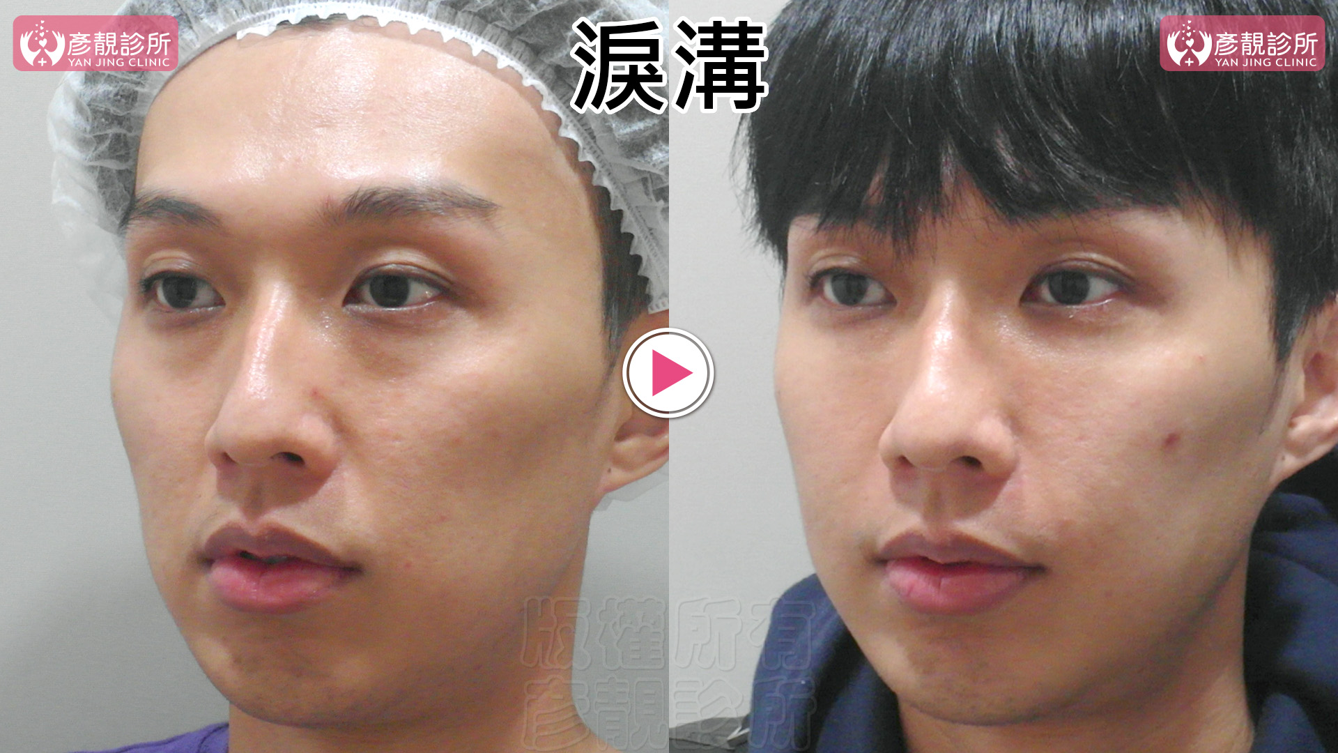 洢蓮絲(俗稱少女針)與大分子玻尿酸怎麼選?淚溝效果、持久度與費用 4 男性淚溝術前術後斜側對照,左圖眼頭下方凹影較深,右圖接受大分子玻尿酸填補後,眼下陰影減輕,臉頰上緣較平順,原有眼型仍清楚。療程評估將填補位置與希望保留的輪廓一起考慮,讓眼神更有精神。