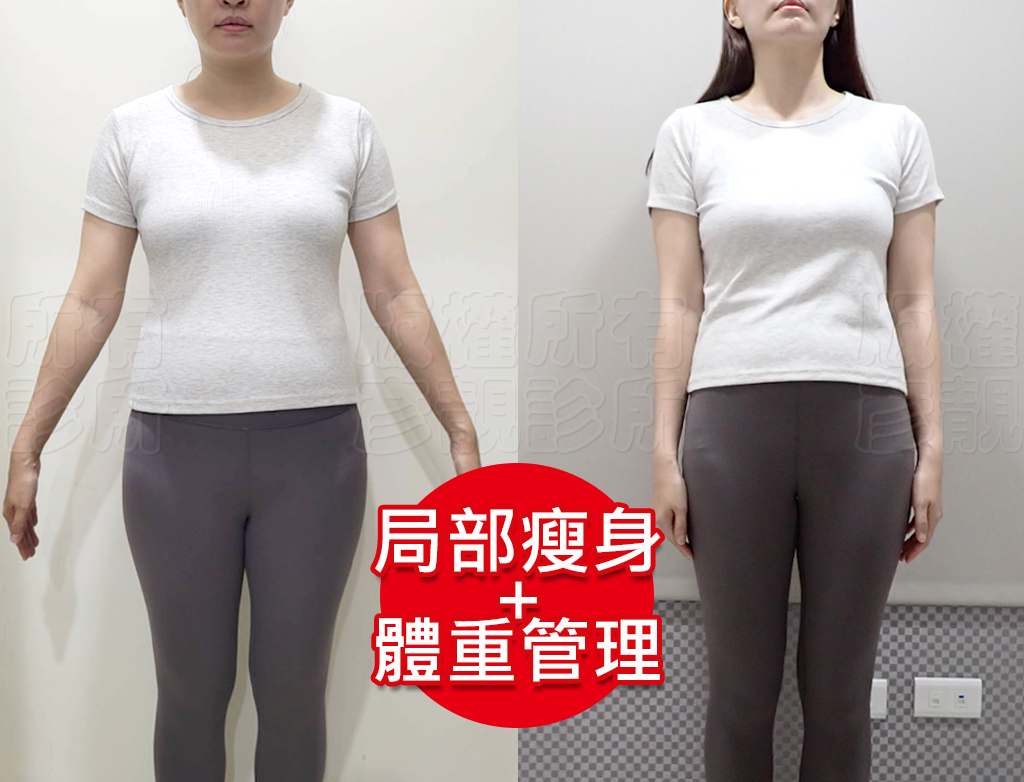 小腹剋星來了! 我的體態管理日記 彥靚診所 - 客製化的健康減重,免挨餓幫我成功瘦回S號!!! 35 211 plate diet