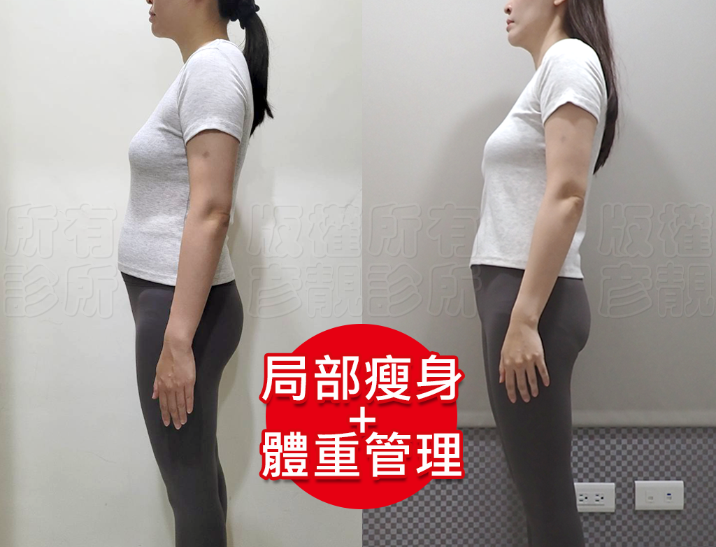 小腹剋星來了! 我的體態管理日記 彥靚診所 - 客製化的健康減重,免挨餓幫我成功瘦回S號!!! 41 belly fat loss