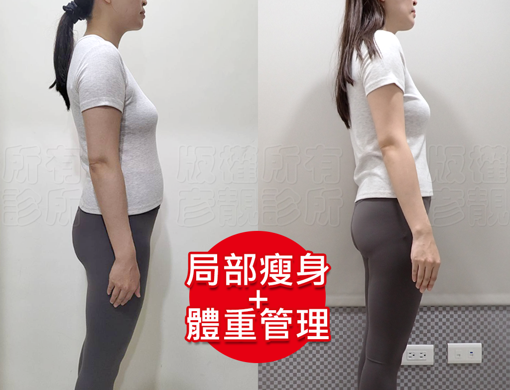 小腹剋星來了! 我的體態管理日記 彥靚診所 - 客製化的健康減重,免挨餓幫我成功瘦回S號!!! 38 medical weight management