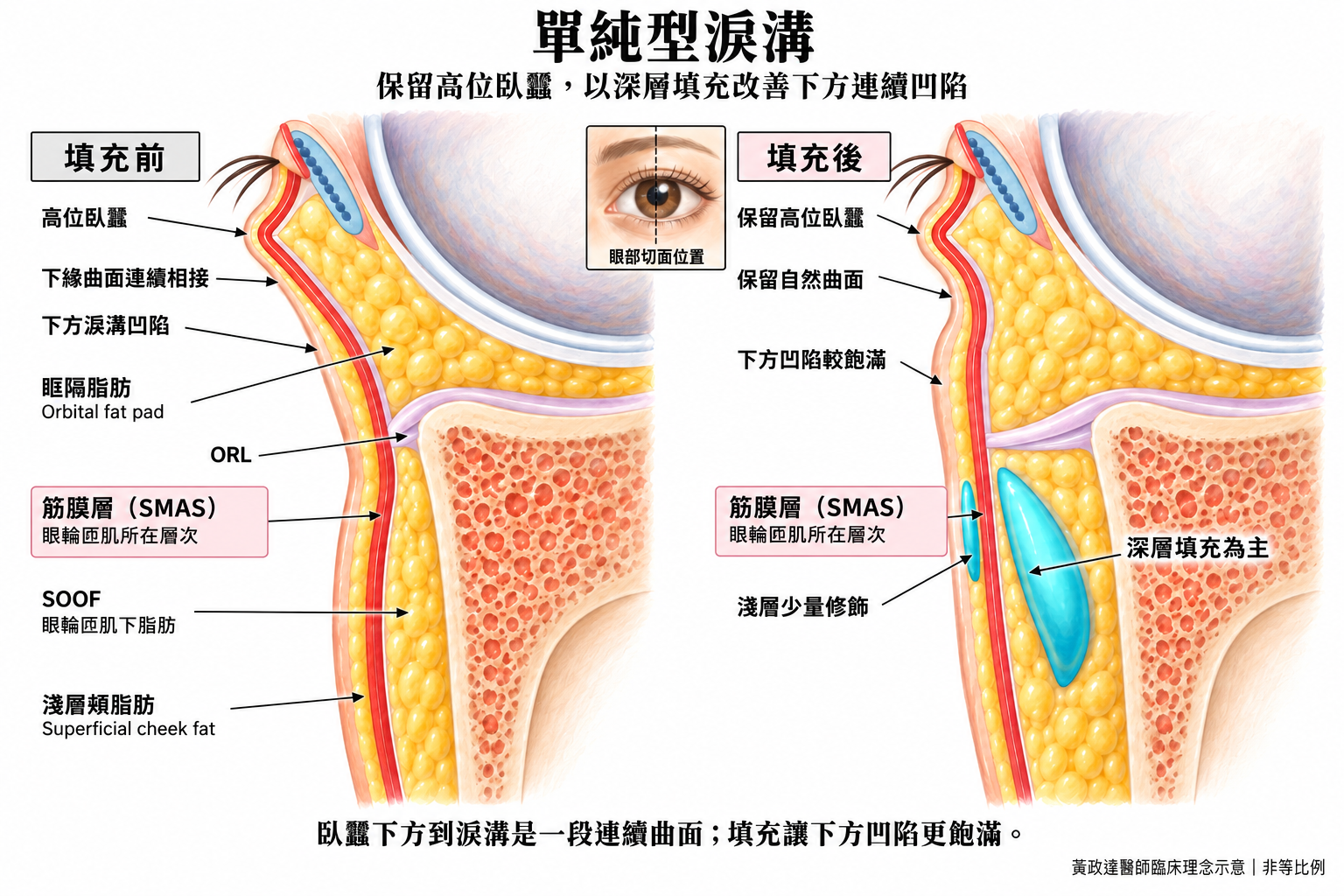 單純型淚溝填充:改善看哪裡?什麼時候需要再補? 5 單純型淚溝深層填充剖面示意,左側高位臥蠶下方的曲面連接淚溝凹陷,右側以深層填充為主、淺層少量修飾,讓下方凹陷較飽滿,同時保留靠近下睫毛的高位臥蠶及下緣自然連續曲面。