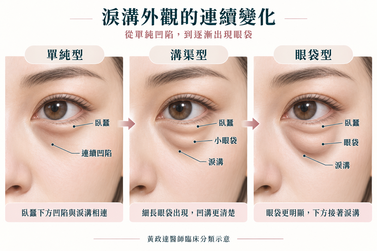 單純型淚溝填充:改善看哪裡?什麼時候需要再補? 2 淚溝外觀連續變化示意,左側單純型的高位臥蠶下方凹陷與淚溝相連,中間溝渠型開始出現細長小眼袋、下方凹溝較清楚,右側眼袋型的隆起更明顯並接著下方淚溝,三欄以同一視角呈現黃政達醫師的臨床分類。