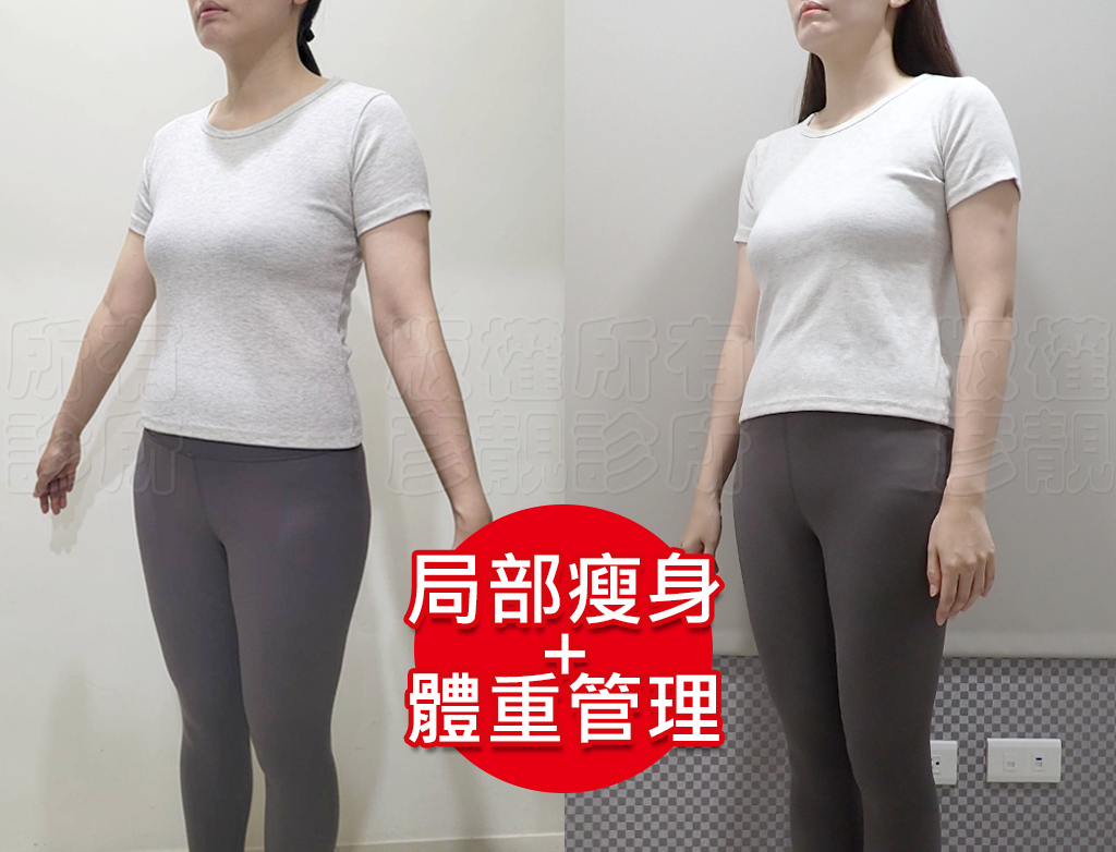小腹剋星來了! 我的體態管理日記 彥靚診所 - 客製化的健康減重,免挨餓幫我成功瘦回S號!!! 39 tcm weight loss
