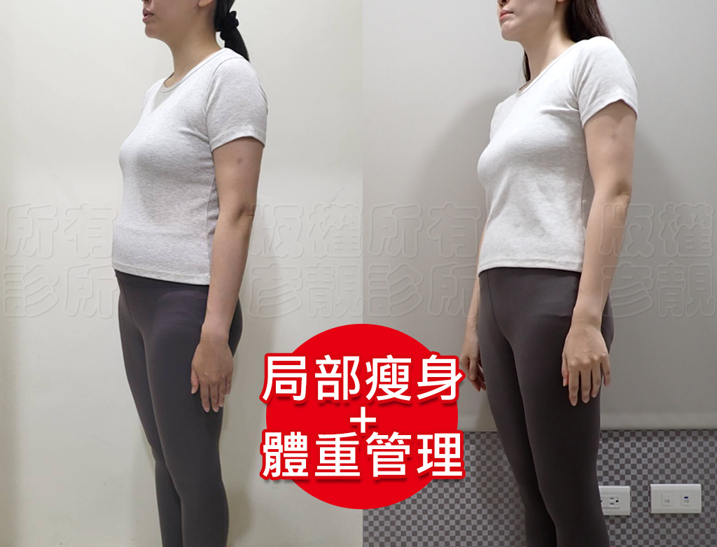 小腹剋星來了! 我的體態管理日記 彥靚診所 - 客製化的健康減重,免挨餓幫我成功瘦回S號!!! 40 weight loss consultation