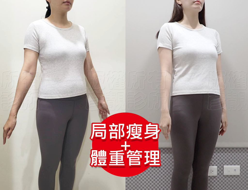小腹剋星來了! 我的體態管理日記 彥靚診所 - 客製化的健康減重,免挨餓幫我成功瘦回S號!!! 36 weight loss methods