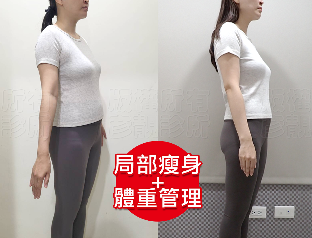 小腹剋星來了! 我的體態管理日記 彥靚診所 - 客製化的健康減重,免挨餓幫我成功瘦回S號!!! 37 weight loss treatment