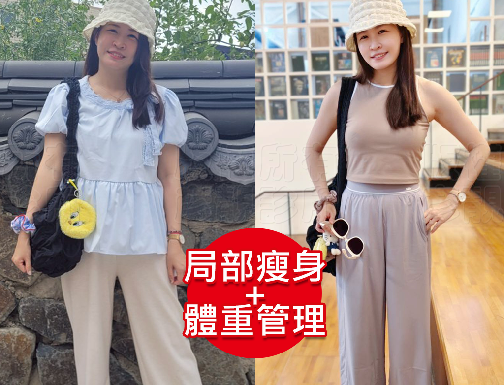 小腹剋星來了! 我的體態管理日記 彥靚診所 - 客製化的健康減重,免挨餓幫我成功瘦回S號!!! 42 yanjing fat loss treatment