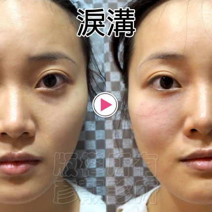 洢蓮絲(俗稱少女針)與大分子玻尿酸怎麼選?淚溝效果、持久度與費用 1 女性正面淚溝填補前後對照,左圖雙眼下方有較寬的凹陷與陰影,右圖使用大分子玻尿酸後,眼頭下方到臉頰的輪廓更連續,靠近下睫毛的自然起伏仍保留,呈現彥靚診所處理單純型淚溝時填補凹陷並保留臥蠶的目標。